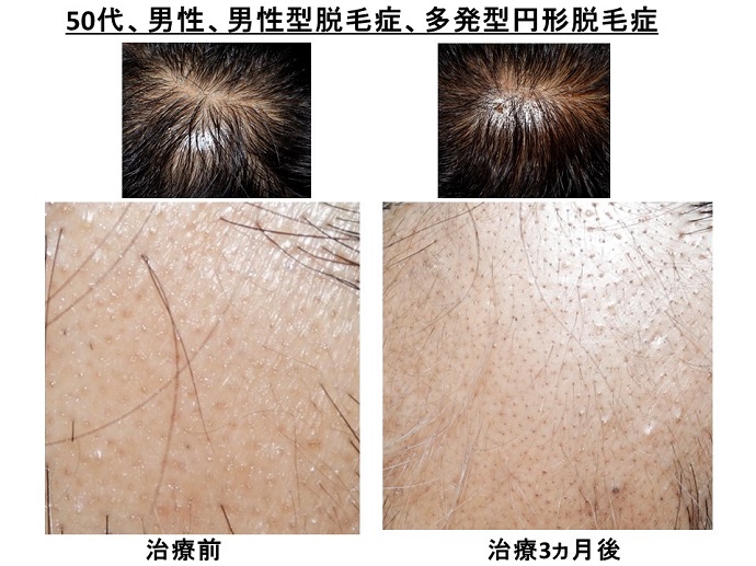 円形脱毛症　病院